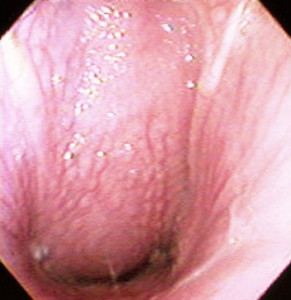 Example of swollen throat